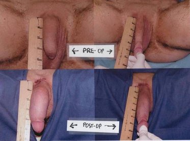 Penis girth enlargement surgery