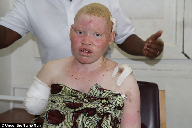 Black albino woman nude