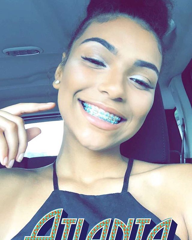 facial Cute teens with gif braces