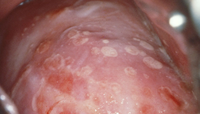 Herpes simplex on penis