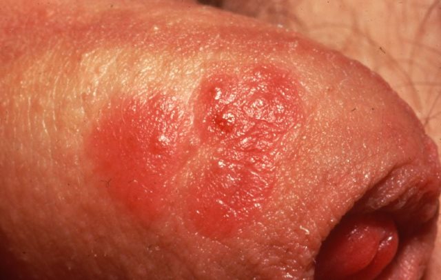 Herpes simplex on penis