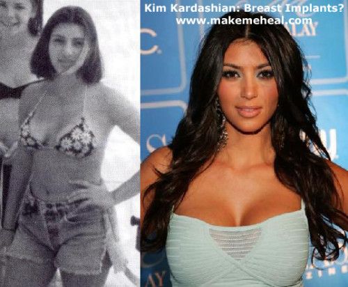 Kim kardashian breast implants